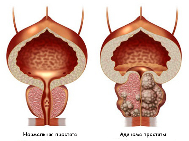болезни половых органов у мужчин