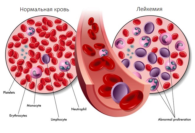Признаки белокровия в крови взрослых людей