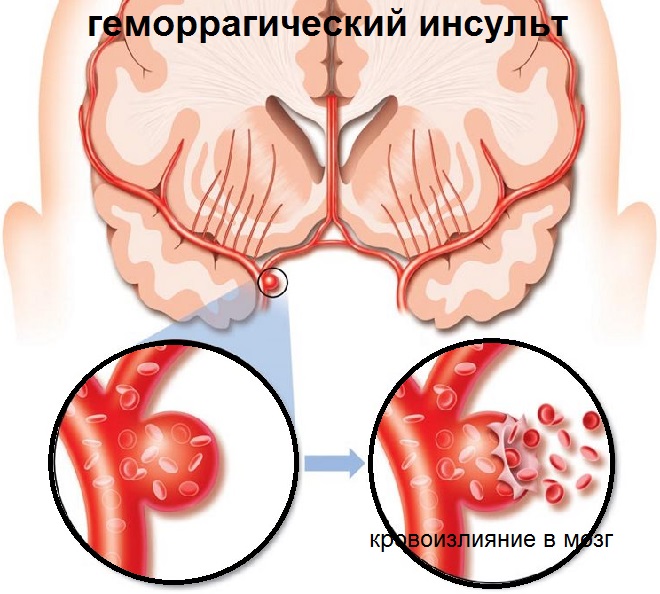 Разрыв стенки сосуда и кровоизлияние в мозг человека