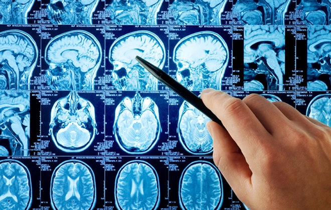 МРТ головного мозга пациента перенесшего инсульт