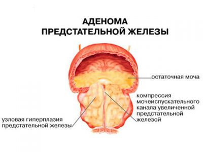 аденома предстательной железы