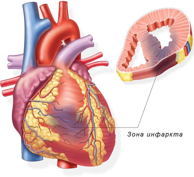 Место поражения сердца при инфаркте миокарда