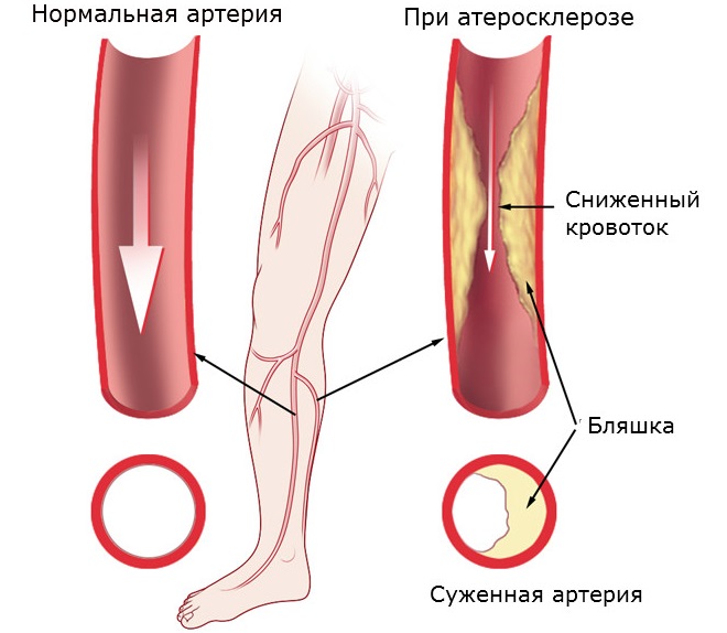 Методы лечения атеросклероза или закупорки вен на ногах