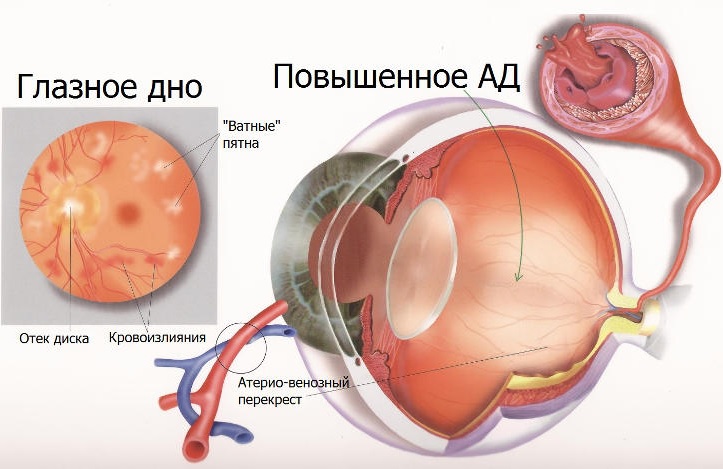 Повышенное артериальное давление глазного дна