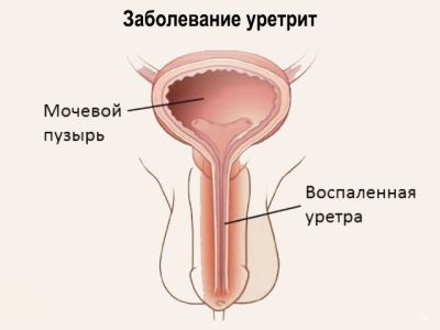 стрептококковый уретрит у мужчин