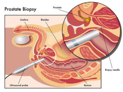 мультифокальная биопсия предстательной железы