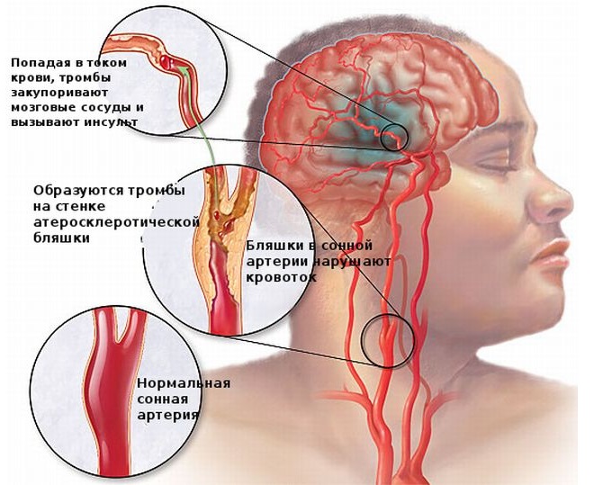 Попадание с кровью тромба в мозг