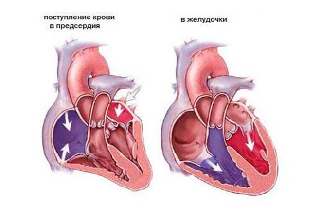 Аневризма сердечная