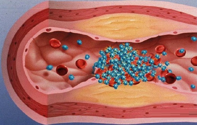 Процесс склеивание тромбоцитов