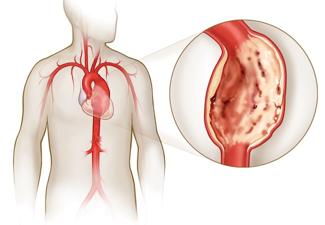 Увеличение аорты ведет к ее разрыву и внутреннему кровотечению