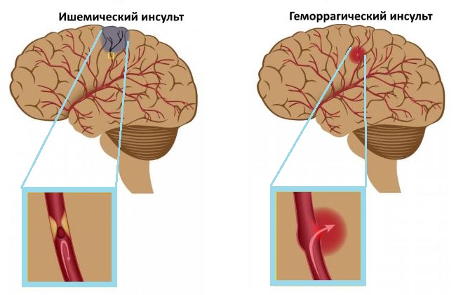 Разновидности инсульта головного мозга