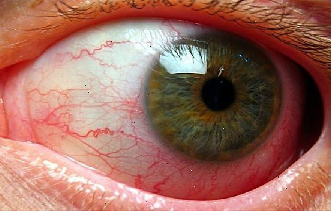 Глаз с воспаленными капиллярами