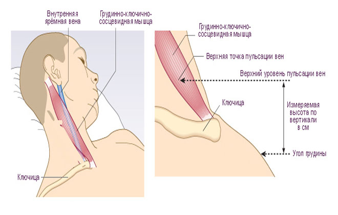 Сильно пульсирует шея. Внутренняя яремная Вена справа. Внутренняя яремная Вена аневризма. Аневризма внутренней яремной вены.