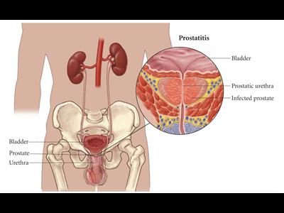 диагностика калькулезного простатита
