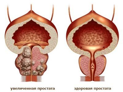 простата и предстательная железа одно и тоже или нет