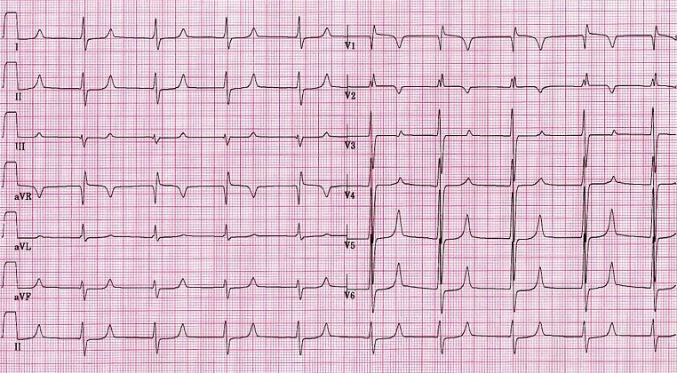 Электрокардиограмма при инфаркте миокарда