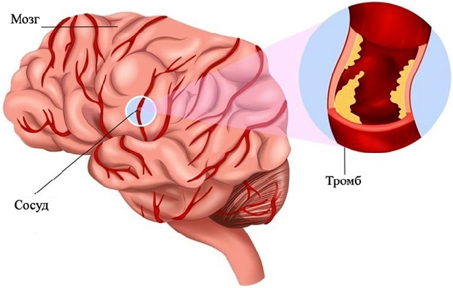 Тромбоз головного мозга