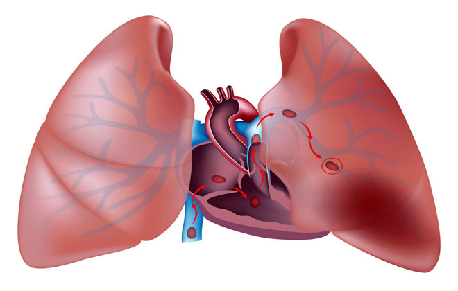 Аневризма артерии на легких