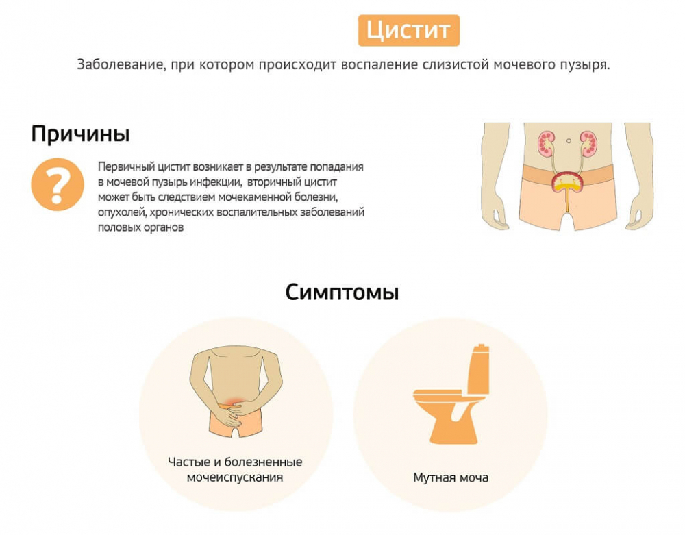Лечение цистита в домашних условиях у женщин — proinfekcii.ru