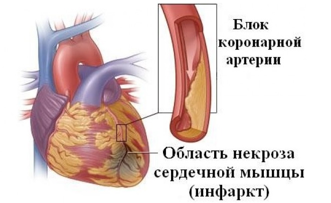 Сердечные артерии забиты холестерином