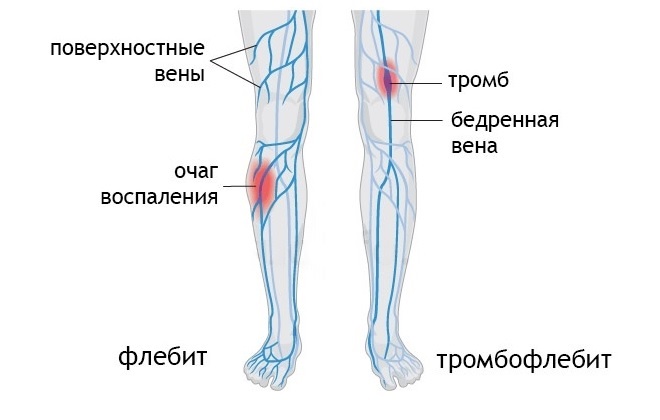 Нарисованные ноги с красными и синими полосками