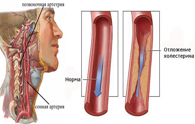 Стеноз или отложение холестерина на стенках артерий