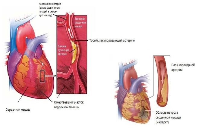 Сердечный тромбоз. Тромбоз коронарных артерий причины. Закупорка тромбов в коронарной артерии. Тромб в сердце оторвался.